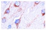 D2DR (B-10): sc-5303. Immunoperoxidase staining of formalin-fixed, paraffin-embedded human brain tumor showing membrane and cytoplasmic staining.