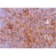 This polyclonal antibody has been discontinued. See our recommended <a href="adamts-1-antibody-3c8f4">ADAMTS-1 (3C8F4)</a> monoclonal antibody (sample data shown). immunohistochemistry image from recommended ADAMTS-1 (3C8F4) monoclonal antibody replacement. Image 377163