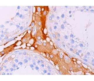 immunohistochemistry image from recommended BUBR1 (8G1) monoclonal antibody replacement. Image 378085