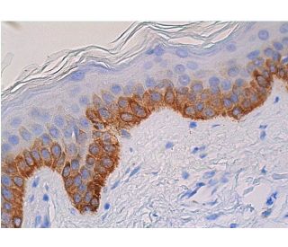 immunohistochemistry image from recommended Cytokeratin 14 (LL001) monoclonal antibody replacement. Image 361375