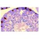 This polyclonal antibody has been discontinued. See our recommended <a href="gata-1-antibody-n6">GATA-1 (N6)</a> monoclonal antibody (sample data shown). immunohistochemistry image from recommended GATA-1 (N6) monoclonal antibody replacement. Image 1179