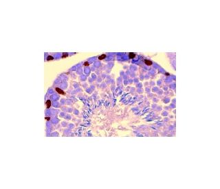 immunohistochemistry image from recommended GATA-1 (N6) monoclonal antibody replacement. Image 1179