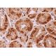 This polyclonal antibody has been discontinued. See our recommended <a href="hmg-i-hmg-y-antibody-d-12">HMG-I/HMG-Y (D-12)</a> monoclonal antibody (sample data shown). immunohistochemistry image from recommended HMG-I/HMG-Y (D-12) monoclonal antibody replacement. Image 375230