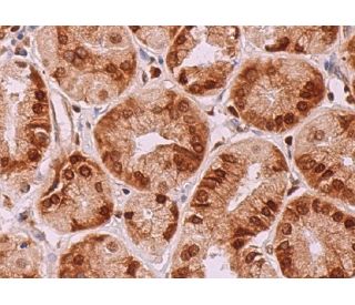 immunohistochemistry image from recommended HMG-I/HMG-Y (D-12) monoclonal antibody replacement. Image 375230