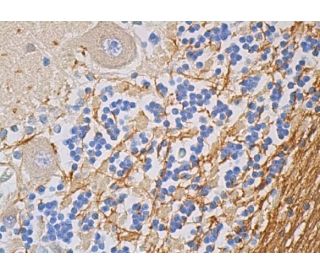 anti mog myelitis