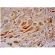 immunohistochemistry image from recommended Nodal (G-10) monoclonal antibody replacement. Image 286421