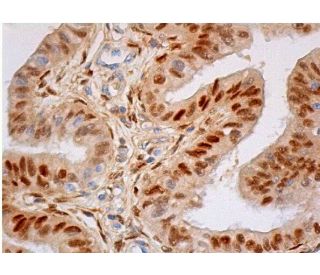 immunohistochemistry image from recommended Progesterone Receptor (F-4) monoclonal antibody replacement. Image 354990