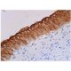 This polyclonal antibody has been discontinued. See our recommended <a href="psca-antibody-7f5">PSCA (7F5)</a> monoclonal antibody (sample data shown). immunohistochemistry image from recommended PSCA (7F5) monoclonal antibody replacement. Image 365280