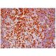 This polyclonal antibody has been discontinued. See our recommended <a href="satb1-antibody-c-6">SATB1 (C-6)</a> monoclonal antibody (sample data shown). immunohistochemistry image from recommended SATB1 (C-6) monoclonal antibody replacement. Image 313916
