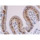 immunohistochemistry image from recommended SNAI 1 (G-7) monoclonal antibody replacement. Image 354986