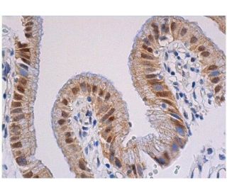 immunohistochemistry image from recommended SNAI 1 (G-7) monoclonal antibody replacement. Image 354986