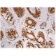 This polyclonal antibody has been discontinued. See our recommended <a href="stat5a-antibody-c-6">Stat5a (C-6)</a> monoclonal antibody (sample data shown). immunohistochemistry image from recommended Stat5a (C-6) monoclonal antibody replacement. Image 160248
