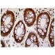 Questo anticorpo policlonale è stato sospeso. Consulta il nostro anticorpo monoclonale <a href="tip60-antibody-c-7">TIP60 (C-7)</a> raccomandato (sono riportati i dati del campione). immunohistochemistry image from recommended TIP60 (C-7) monoclonal antibody replacement. Image 158894
