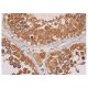 immunohistochemistry image from recommended WT1 (H-1) monoclonal antibody replacement. Image 351538