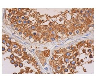 immunohistochemistry image from recommended WT1 (H-1) monoclonal antibody replacement. Image 351538